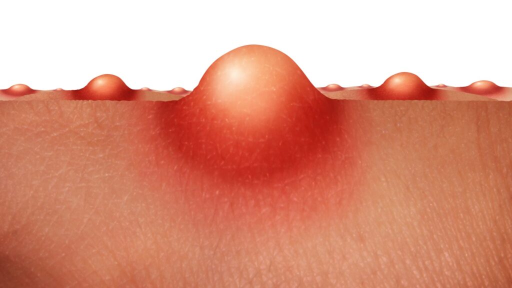L'acné provient d'une accumulation localisée de sébum. // Source : Canva