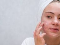 L'acné sur le visage provient d'une hypersécrétion de sébum. // Source : Canva