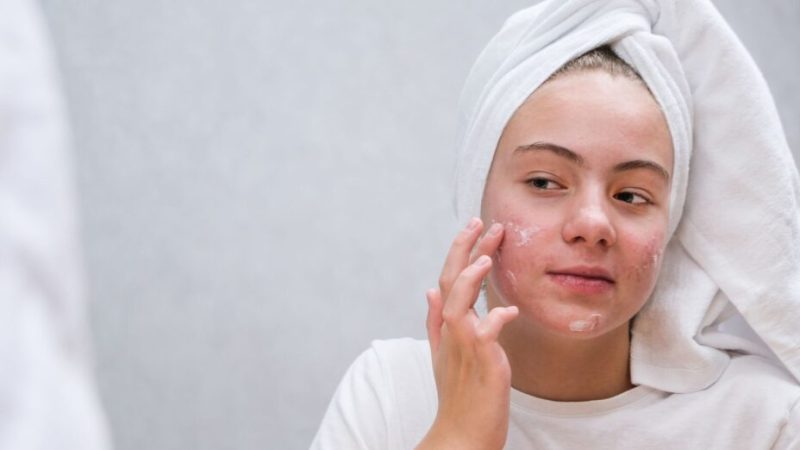 Les scientifiques ont retourné l’acné contre elle-même pour qu’elle s’autodétruise