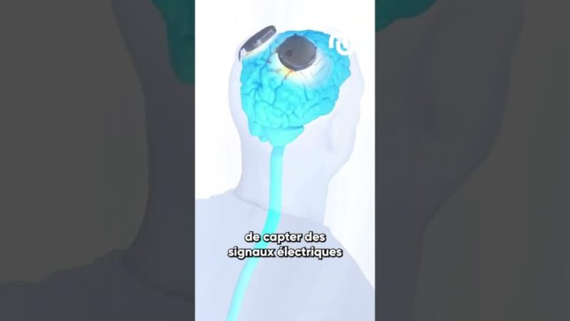 Un implant qui permet aux personnes handicapées de marcher à nouveau ?