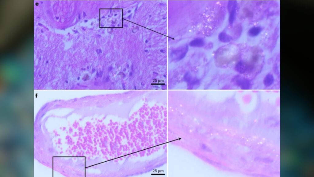 Les micro- et nano-plastiques ne sont pas visibles à l'oeil nu. Ils proviennent de la dégradation de morceaux plus gros de plastique, avant de s'éparpiller dans la nature et les tissus organiques. // Source : Nature Medecine, Nihart et al, 2025