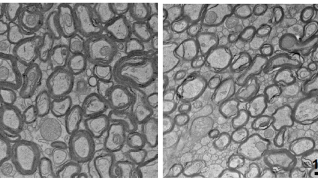 La carence en lithium a aminci la myéline qui recouvre les neurones (à droite) par rapport aux souris normales (à gauche). // Source : Laboratoire Yankner