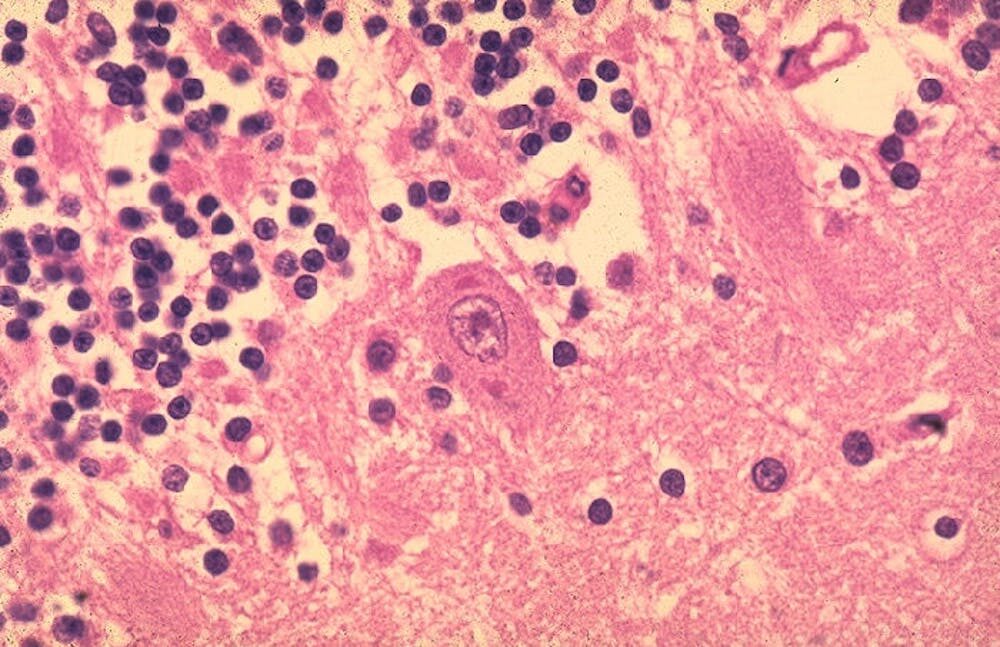 Le virus affecte le cerveau, comme on le voit avec les inclusions violettes plus foncées, appelées corps de Negri, dans les cellules cérébrales d’une personne morte de la rage. // Source :  CDC/Dr. Makonnen Fekadu Le virus affecte le cerveau, comme on le voit avec les inclusions violettes plus foncées, appelées corps de Negri, dans les cellules cérébrales d’une personne morte de la rage. // Source :  CDC/Dr. Makonnen Fekadu